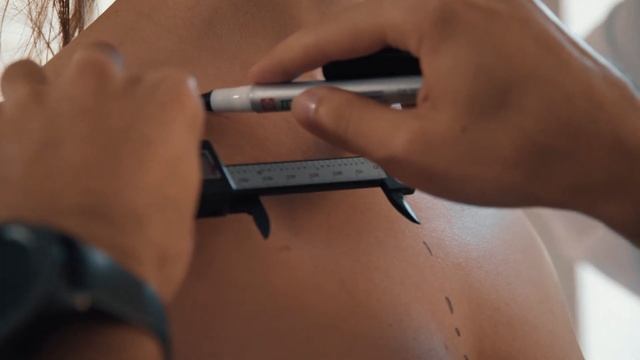 Увеличение груди с подтяжкой на имплантах. Случай из практики