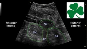 The Anterior Quadratus Lumborum (QL) Block