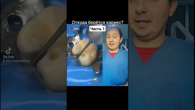 Причины возникновения кариеса-1 #стоматолог #стоматология #кариес #лечениекариеса #гигиенаполостирт