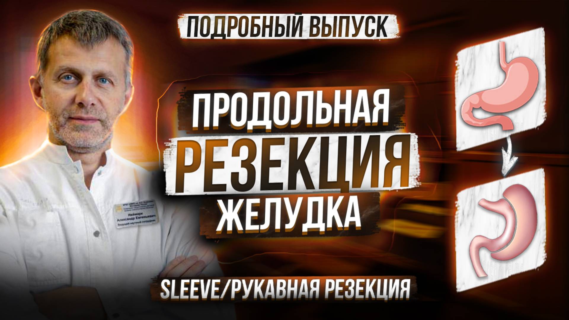 ПРОДОЛЬНАЯ РЕЗЕКЦИЯ ЖЕЛУДКА • SLEEVE • СЛИВ • РУКАВНАЯ РЕЗЕКЦИЯ •схема операции, технические нюансы
