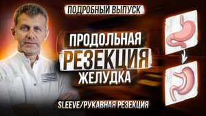 ПРОДОЛЬНАЯ РЕЗЕКЦИЯ ЖЕЛУДКА • SLEEVE • СЛИВ • РУКАВНАЯ РЕЗЕКЦИЯ •схема операции, технические нюансы