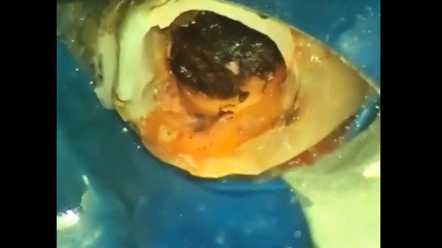 Для вебинара 3 распломбировка рф пасты смотреть онлайн