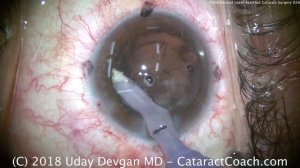 femtosecond laser assisted cataract surgery -- is it worth the cost?