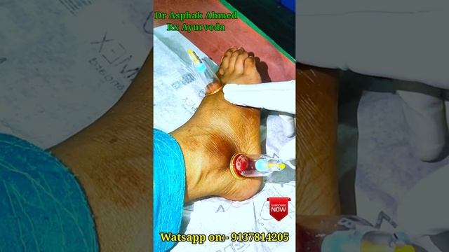 Hijama for uric acid || Cupping Therapy in Gout || Hijama in Lucknow || Cupping in Lucknow || #shor