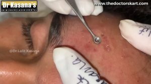 Blackhead Removal by Dr.Lalit Kasana / Best Blackhead Removal Video