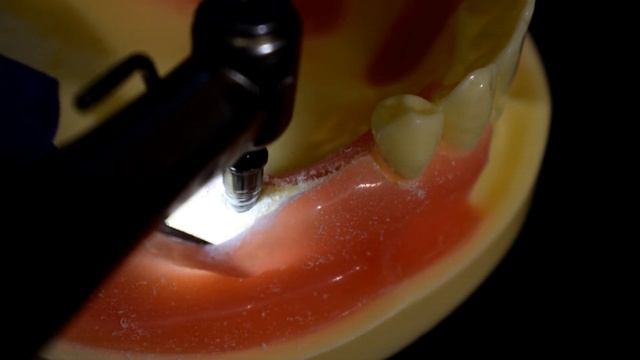 Дентальная имплантация зубов в большом увеличение!!! смотреть онлайн