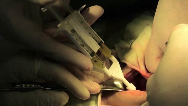 Заклеивание забрюшинного пространства смотреть онлайн