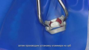 Методика наложения коффердама способ 2