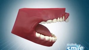 виниры перфект смайл инструкция