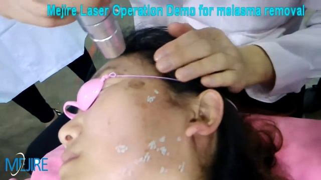 Q Switch Nd yag Laser Removal Melasma