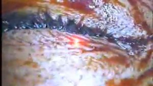 LASIK eye surgery with Pendular Microkeratome