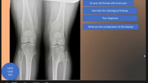 OECE Case 010 : Hereditary multiple exostoses/osteochondromas, also known as diaphyseal aclasis