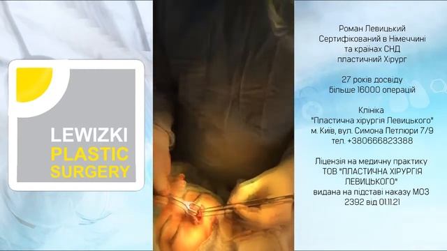Ринопластика І Пластика носа І Професійна анестезія І Роман Левицький пластичний хірург