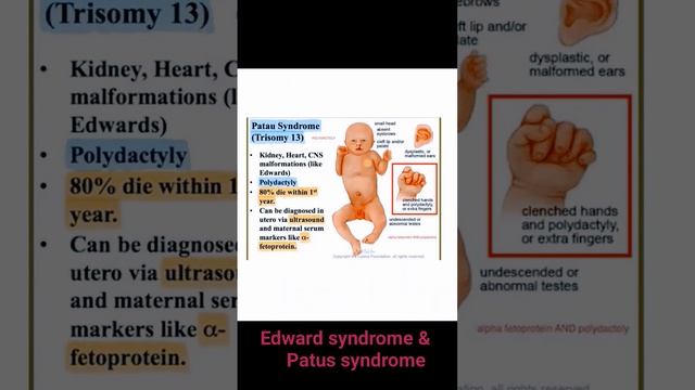 Autosomal Trisomy | Edward syndrome & Patu's syndrome