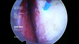 HoLEP 3 Lobe Technique  Dmitry Surenkov/Гольмиевая лазерная энуклеация простаты 3-х долевая техника