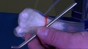 Интрамедуллярный остеосинтез переломов плечевой кости у детей с применением TEN