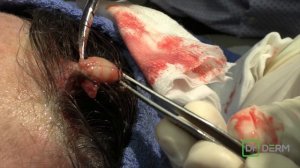 4 Year Old Mystery Cyst | Dr. Derm