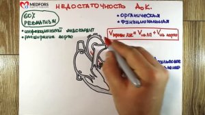 Аортальная недостаточность Просто о сложном