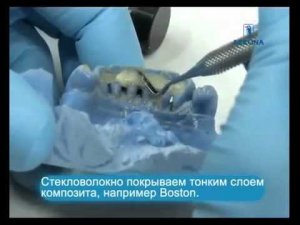 Шинирование зубов прямым или непрямым методом