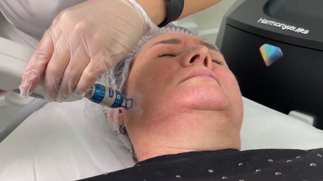 Лазерное омоложение лица и век эрбиевым лазером смотреть онлайн