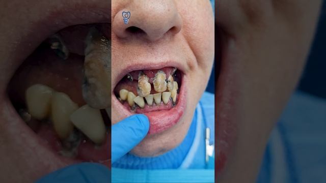 Вот такая исходная ситуация и выраженная отёчность. Планируем удалить 19 зубов. Имплантация зубов.