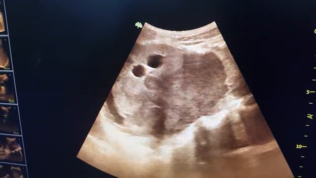 GIST(Gastrointestinal stromal tumour) 😰🥺😱🙏 смотреть онлайн