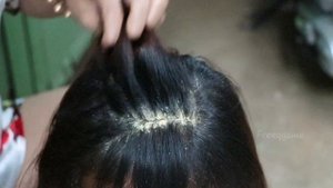Removed Hundred of Lice From Head and Dry Scalp Huge Dandruff of Flakes Removal With Comb # 1765