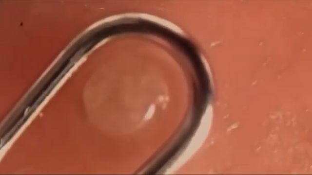 Выдавливание прыщей и черных точек