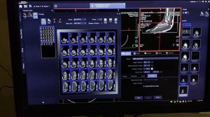 CT scan Foot/Ankle 3D, filming,Siemens healthineers SOMATOM. go CT Scan.