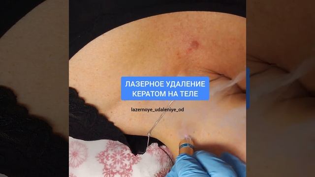 Лазерное удаление кератомы на теле