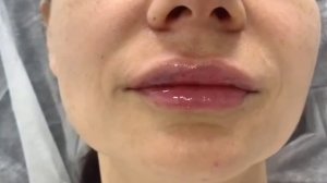 Увеличение губ: до и после