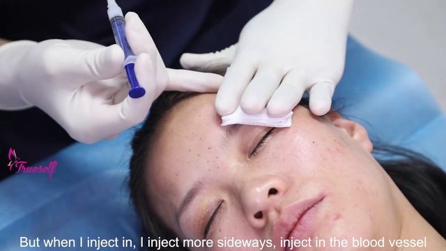 Trueself PLLA dermal filler 400 for forehead