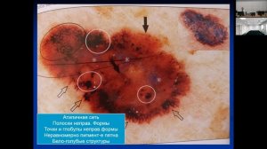 ИГМУ_Кафедра_онкологии_и_лучевой_терапии. Предраки и злокачественные опухоли кожи