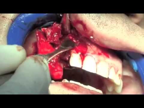 Остеопластика с материалами OsteoBiol