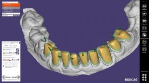 Виниры Exocad:2)Создание мин. толщины и цементного зазора в Exocad / Veneers Exocad:2) Crown Bottom