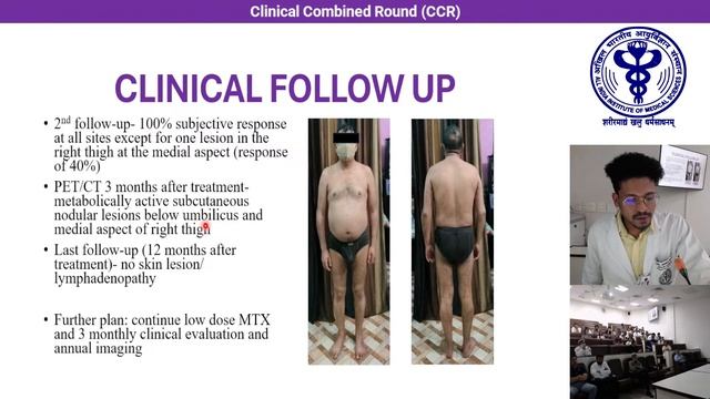 Total skin electron beam therapy in cutaneous T-Cell lymphoma смотреть онлайн