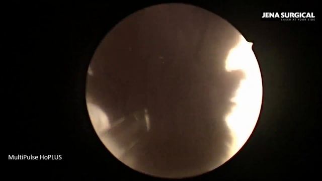 HoLEP. En-block technique. Laser enucleation of BHP 110 cc by MultiPulse HoPLUS. Artem Gonyaev. смотреть онлайн