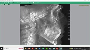 Цефалометрический расчет по реконструкции ТРГ из КТ. RecoCeph