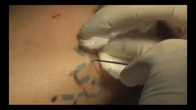 Минифлебэктомия