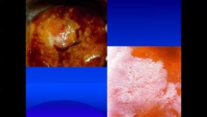 ИГМУ_Кафедра_онкологии_и_лучевой_терапии. Онкогинекология