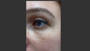 Классическая блефаропластика верхних и нижних век с иссечением кожи на нижних веках