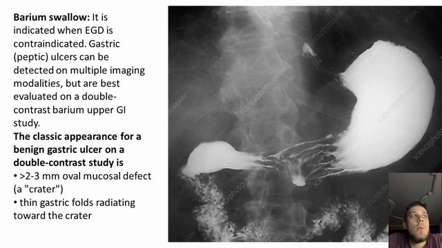 Diagnosis of Peptic Ulcer Disease