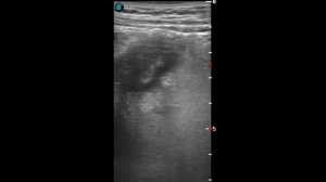 Дивертикулит сигмовидной кишки. Sigma's diverticulitis