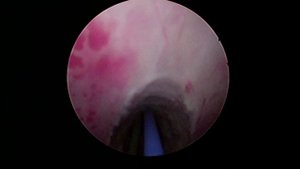 Urethral Stricture Treatment with the Holmium Laser/Лазерная внутренняя оптическая уретротомия/ВОУТ