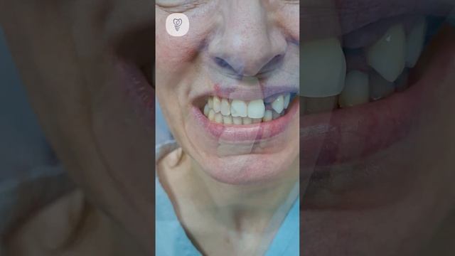 Моделировка и примерка новой улыбки. Через неделю меняем на постоянные. Имплантация зубов.