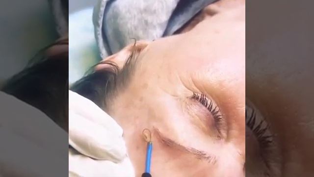 Удаление себорейной кератомы методом радиоволновой деструкции.