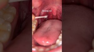 Massage the tonsils.Week 16. Tonsil stone removal.@tonsilstar #fyp #foryou
