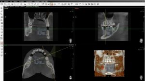Планирование имплантации зубов в Ez3D Plus
