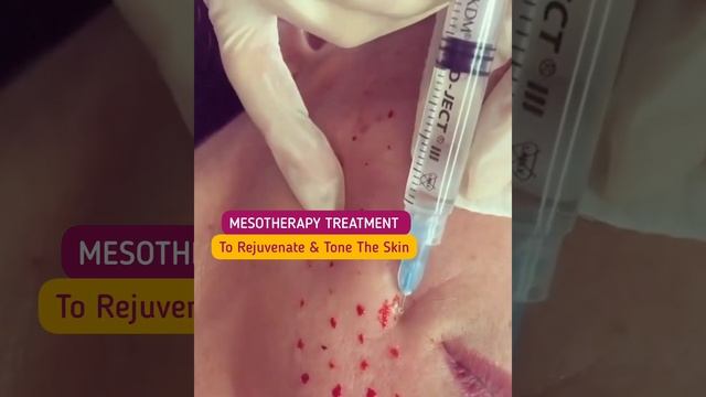 Mesotherapy Treatment | All You Need To FAQs