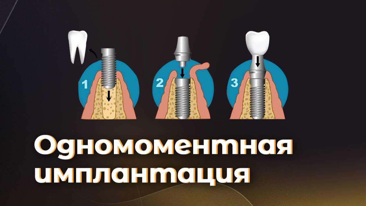 Одномоментная имплантация. #AlconDentalClinic #СтоматологияНаСоколе #ЗдороваяУлыбка